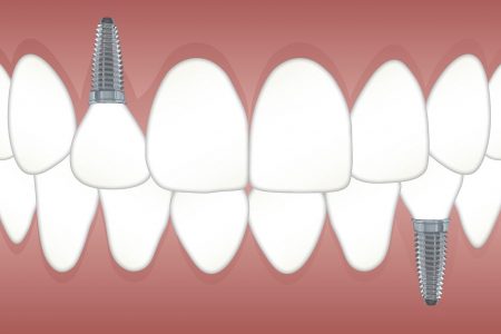 #implant-dentaire-remboursement